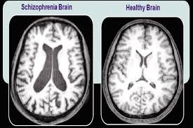 What-is-Schizophrenia--Symptoms-and-causes